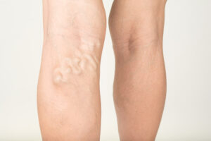 Varicose veins in the legs