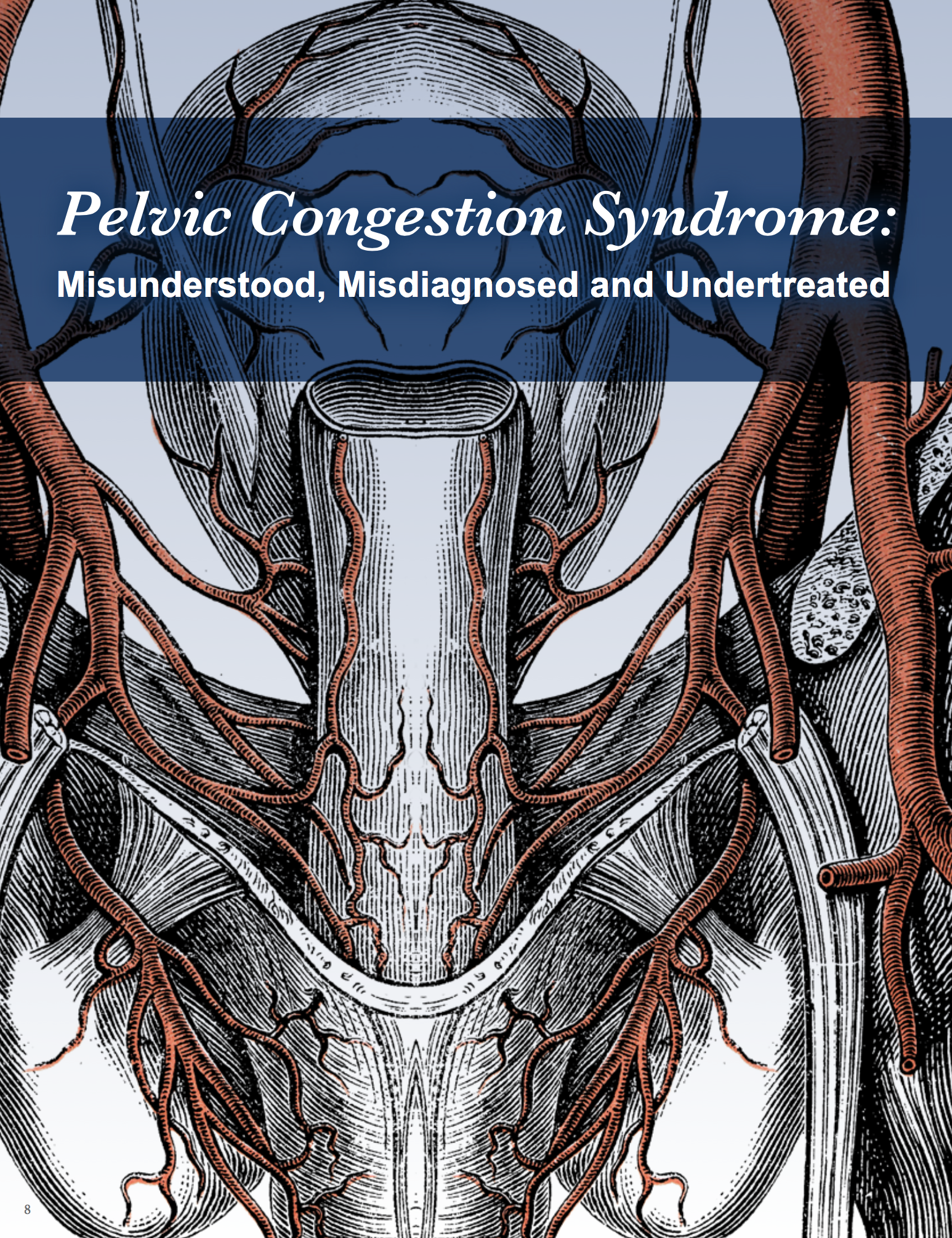 Pelvic Congestion Syndrome - Vein Center, Dallas, TX