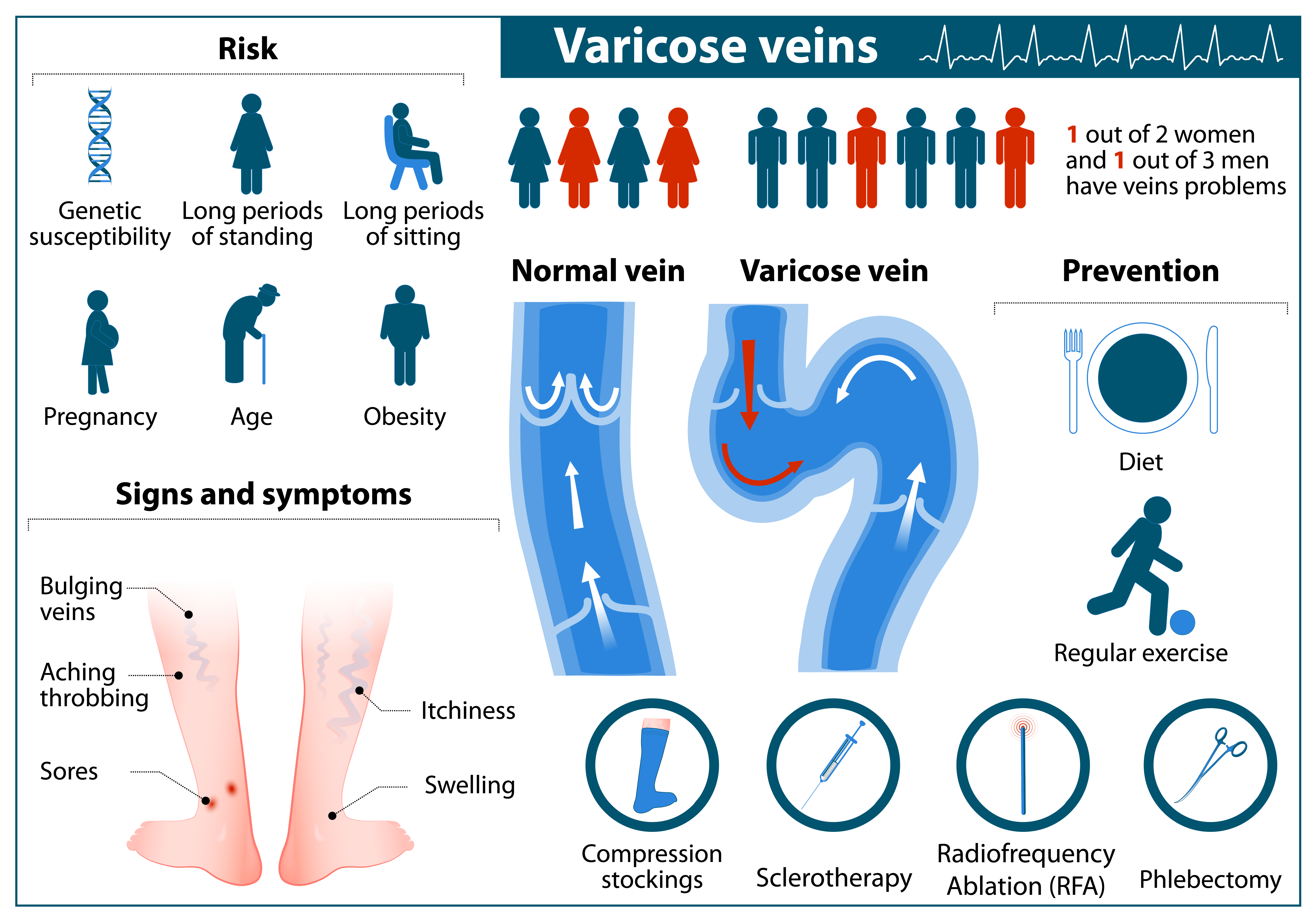 Varicose Veins Diagram: Risk, Signs and Symptoms, Treatments, Prevention